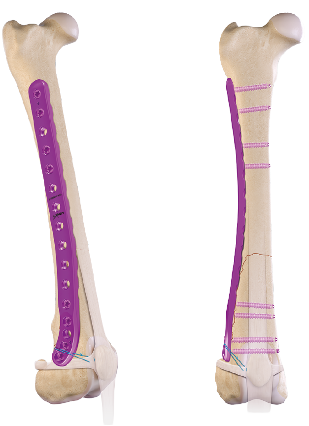 frakturversorgung-02