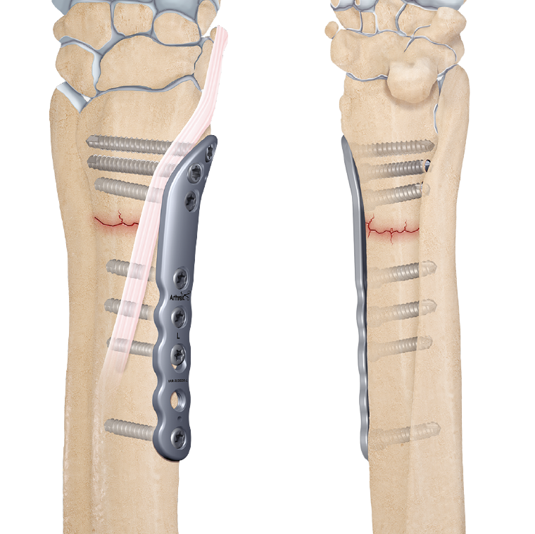 frakturversorgung-06